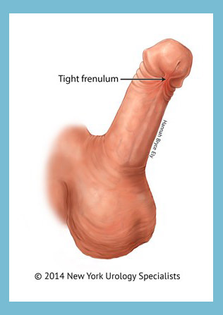 Penis frenectomy for men in Melbourne